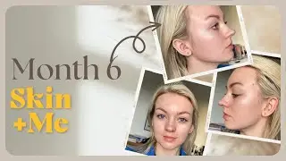 Skin +Me, Month 6 Review | Clearing My Pigmentation