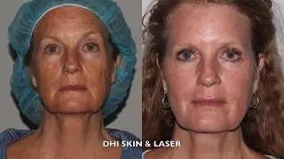 Derma Health Laser Skin Resurfacing | Active FX Patient Testimony