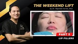 The Weekend Lift Part 5: Lip Fillers