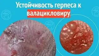 😕 Устойчивость герпеса к валацикловиру. Клинический случай №1184