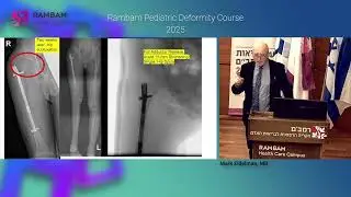 Rambam Pediatric Limb Deformity Course 2025 - Mark Eidelman (L 16)