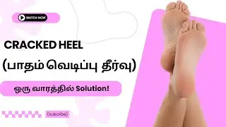 How to Cure Cracked Heels at Home | Soft Feet in 7 Days | Natural & Simple Treatment
