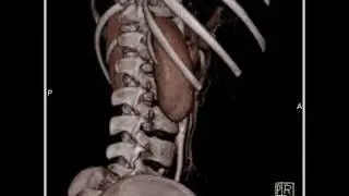 MDCT 64 Kidney: VRT mapping of child (1 of 2)