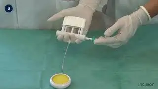 Vacuum-Assisted Delivery - Incision Academy
