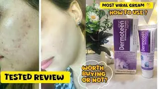 Dermoteen whitening cream review|| medicated whitening cream honest review ✨