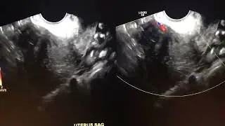 TVUS  Fibroid- Anterior- Radarchif