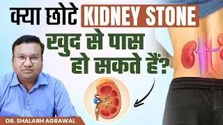 Small kidney stones: Is it possible to pass them naturally? Small kidney treatment options - Dr. ...