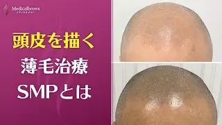 まだ、みんな知らない方法　#薄毛改善 #AGA治療