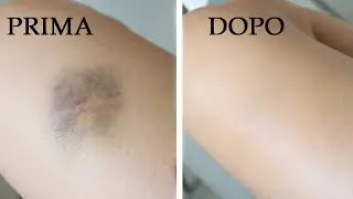 Trucco camouflage facile per coprire ematomi, venuzze bluastre e tatuaggi