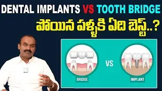 డెంటల్ ఇంప్లాంట్స్ | Dental Implant Process Step by Step Telugu |Dr.MS RangaReddy@iDreamhealthmantra