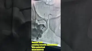 VENOUS LEAK TREATMENT BY EMBOLIZATION | cause of erectile dysfunction