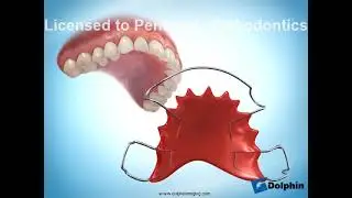 Hawley Retainer Compliance Maxillary