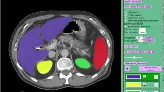 Segmenting abdominal organs with MedSeg