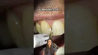 smoker&rsquo;s teeth cleaning #shorts