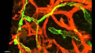 JID March 2024:Coverage of Smooth Muscle Cells on Lymphatic Capillaries in Secondary Lymphedema Skin