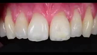 ICON resin infiltration