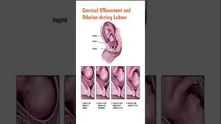 cervical effacement#rinkoosingh