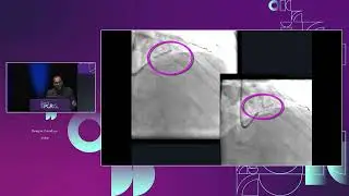 Next-generation complex PCI toolkit and novel balloon-expandable Myval THV - GulfPCR-GIM 2023