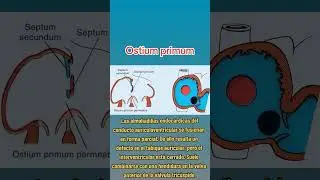 Ostium primum #ostium #viralshort