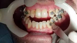 ADHESION BRACKETS DR GALLARDO CLINICAORTODONCIAJAEN