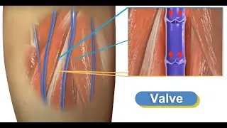 How does the endovenous laser therapy (EVLT) machine for varicose veins surgery work?