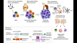 T-Cell Large Granular Lymphocytic Leukemia (T-LGL)  ; Causes, Types, Symptoms, Treatment