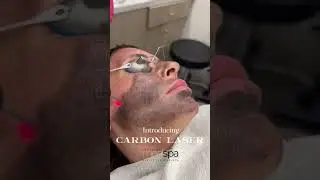 New Carbon Laser Peel - No Downtime Treatment For Event Ready Skin
