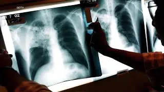 Kansas City is dealing with largest tuberculosis outbreak in US history