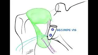 The Open Capsular Shift Latarjet Procedure Comics