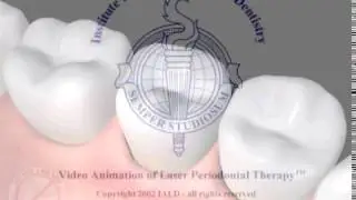 LANAP video