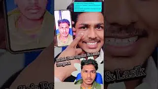Squint Surgery Success | 1 Month Post-Op Amazing Result | Dr M A Siddiqui | Best Eye Doctor #squint