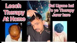 How to do leech therapy at home? | Leech Therapy at Home | Benefits of leech therapy