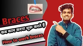 Braces |braces kab kam karna suru karta hein or changes jab Nazar aate hein |how to work braces on t