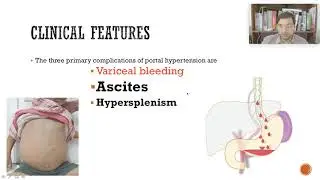 ASCITES, Rog Nidan,  BAMS 2nd yr,LBS Mahila Ayurvedic College, Bilaspur, Haryana,