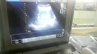 Liver ECO6 Chison