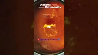 CSME | Hard Exudates | Diabetic retinopathy | Fundus Photography | Short Video 415