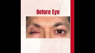 Artificial eye movements| Prosthetic eye