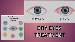 Say Goodbye to Dry Eyes | Dr. Narinder Ravi Goyal