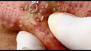 How to use a blackhead removal tool 2021