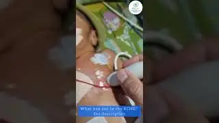 35 weeks with distress, on CPAP for 2 days referred for ECHO.