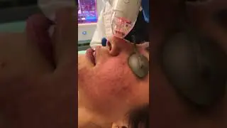The Vivace Experience  - Avalon Laser - Dr. Reza Tirgari