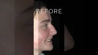 Before & After Rhinoplasty Surgery: Dorsal Hump & Bulbous Tip #nosejobbeforeandafter #nosejobs