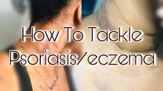 Psoriasis/eczema Breakouts ? What To Do | Gabbybaddd Curly