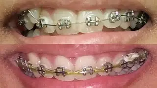 My Braces Journey (High Canine Treatment)