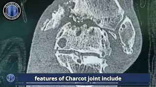 Charcot Neuro-Osteoarthropathy (Charcot Joint) - Dr. Dharmalingam Muthiah