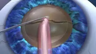 Laser Assisted Cataract Surgery at Vision Mendez.