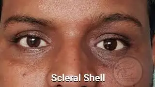 Artificial Eye 3D Custom Made Artificial Eye Global Prosthetic Eye Center,Delhi,India