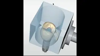 Screw Retained Dio Crown using CEREC