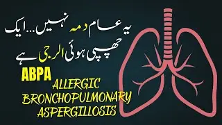 Allergic Bronchopulmonary Aspergillosis (ABPA) Explained | Hidden Lung Allergy You Must Know
