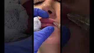 Lip filler in Austin, TX #shorts